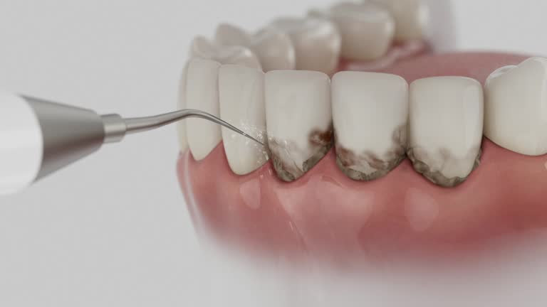 Trusted Teeth Cleaning And Checkup service in Fort Pierre, SD - Dentist Open Now